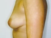 Breast Augmentation Patient 02 Before