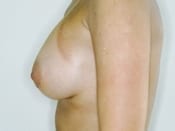 Breast Augmentation Patient 02 After - 2