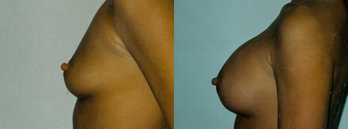 Breast Augmentation Before and After Photos