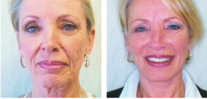 Facelift patient of Dr. Moser Before and after photos