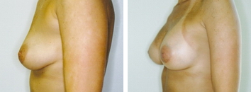 Breast Revision Before and After Photos