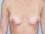 Breast Augmentation Patient 04 Before