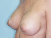 Breast Augmentation in Orange County After Patient 2
