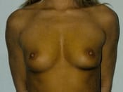 Breast Augmentation Patient 05 Before