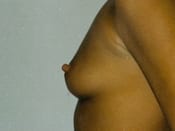 Breast Augmentation Patient 05 Before - 2