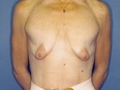 Breast Lift Patient 02 Before