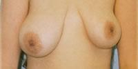 Breast Reconstruction Patient 01 Before