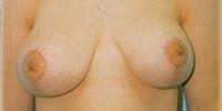 Breast Reconstruction Patient 01 After