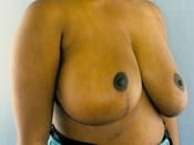 Breast Reduction Patient 01 After