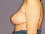 Breast Reduction Patient 02 After