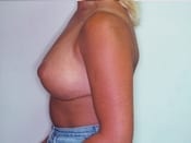 Breast Reduction Patient 03 After - 2