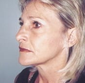 Face Lift Patient 2 Before - 2