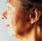 Face Lift Patient 5 Before