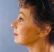 Face Lift Patient 5 After