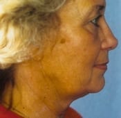 Chin Augmentation Patient 01 Before