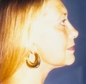 Face Lift Patient 6 After