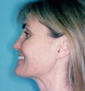 Laser Skin Resurfacing Patient 02 Before - 2