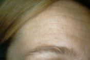 Laser Skin Resurfacing Patient 03 Before