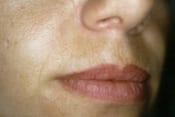 Laser Skin Resurfacing Patient 03 Before - 2