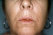 Laser Skin Resurfacing Patient 04 Before - 2