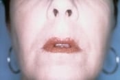 Laser Skin Resurfacing Patient 04 After - 2