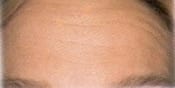 Laser Skin Resurfacing Patient 06 Before