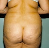 Liposuction (Female) Patient 01 Before