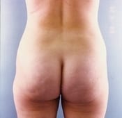 Liposuction (Female) Patient 01 After