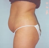 Liposuction (Female) Patient 02 Before