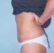 Liposuction (Female) Patient 02 After