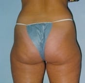 Liposuction (Female) Patient 03 Before