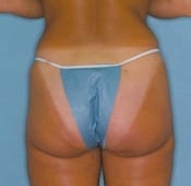 Liposuction (Female) Patient 03 After