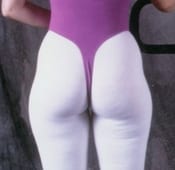 Liposuction (Female) Patient 04 Before