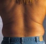 Liposuction (Male) Patient 01 Before