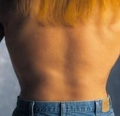 Liposuction (Male) Patient 01 After