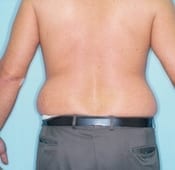 Liposuction (Male) Patient 02 Before
