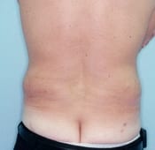 Liposuction (Male) Patient 02 After