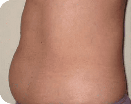 Fat Melting Patient 11 After