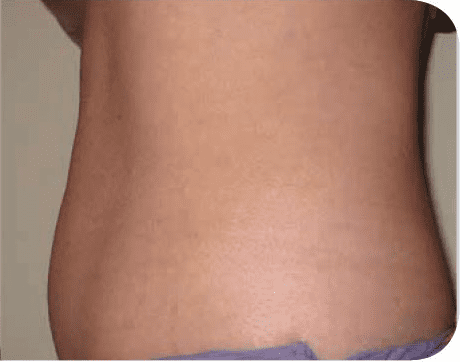 Fat Melting Patient 11 Before