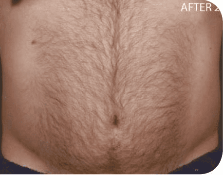 Fat Melting Patient 12 After