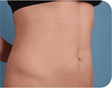 Fat Melting Patient 01 After