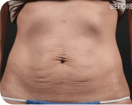 Fat Melting Patient 02 Before