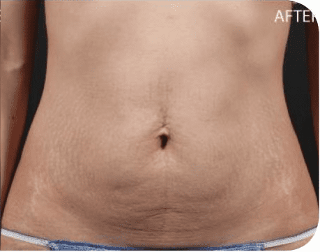 Fat Melting Patient 02 After