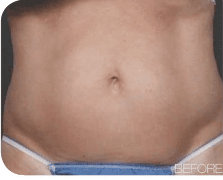 Fat Melting Patient 03 Before