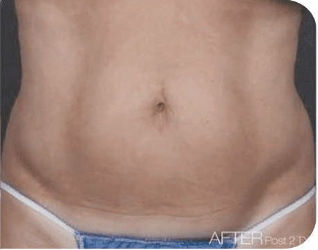 Fat Melting Patient 03 After