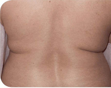 Fat Melting Patient 06 Before