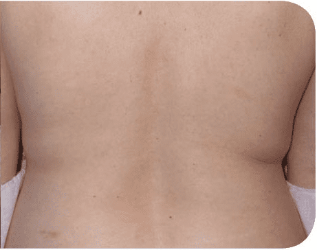 Fat Melting Patient 06 After