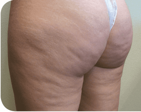 Fat Melting Patient 07 Before