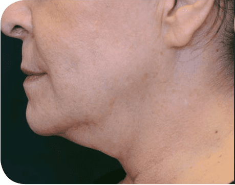 Fat Melting Patient 08 Before