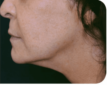 Fat Melting Patient 08 After